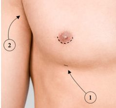 胸肌線手術示意圖1