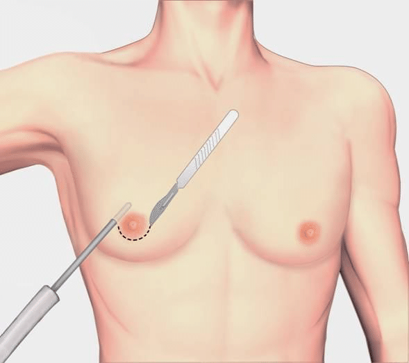 進階術式：威塑抽脂合併局部乳腺切除1