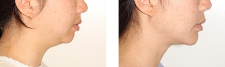 雙下巴抽脂 術後線條參考
case3-前後對比照