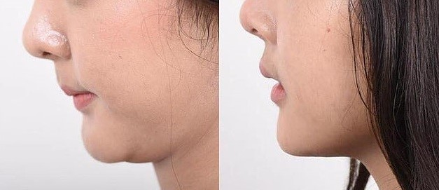 雙下巴抽脂 術後線條參考
case4-前後對比照