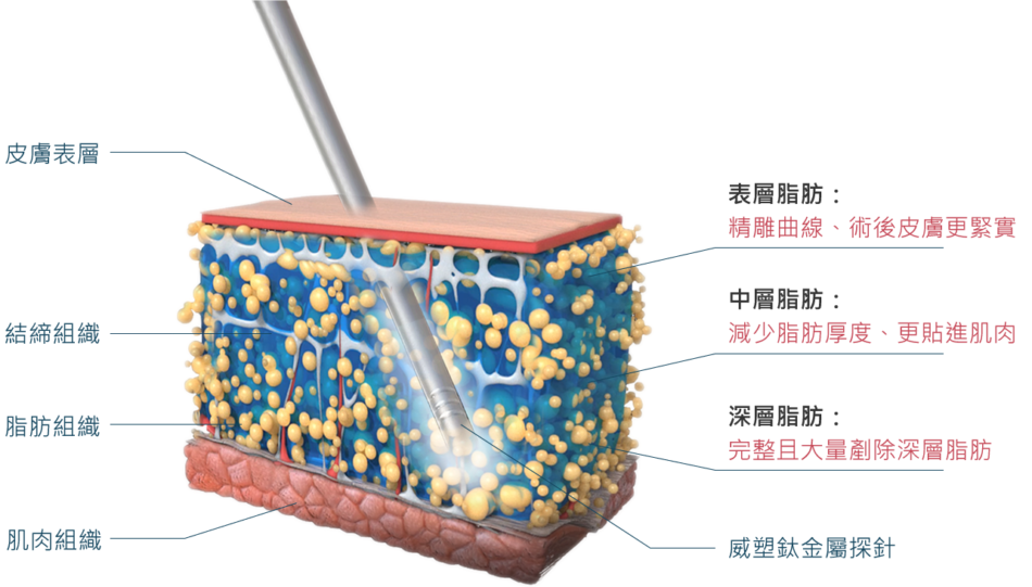 威塑（VASER）在下臉部脂雕的應用