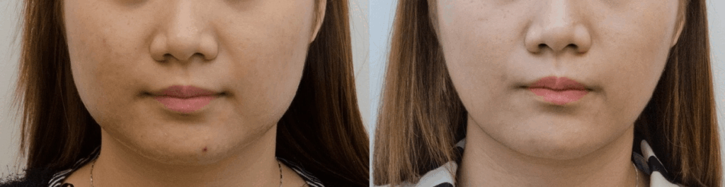 下臉部脂雕術案例1