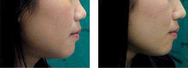 下臉部脂雕術案例2