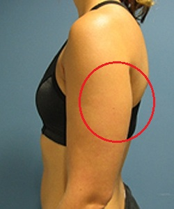 脂肪手臂蝴蝶袖