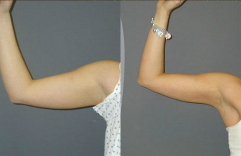 手臂抽脂：術前術後比較1