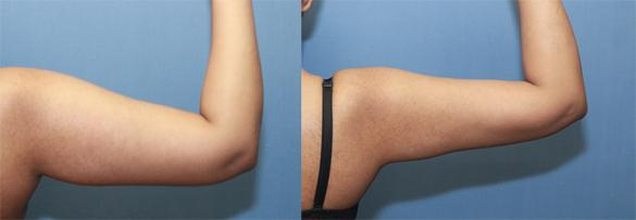 手臂抽脂：術前術後比較2