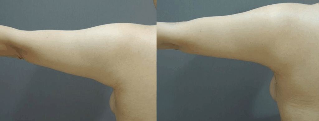 CASE 1 手臂抽脂1