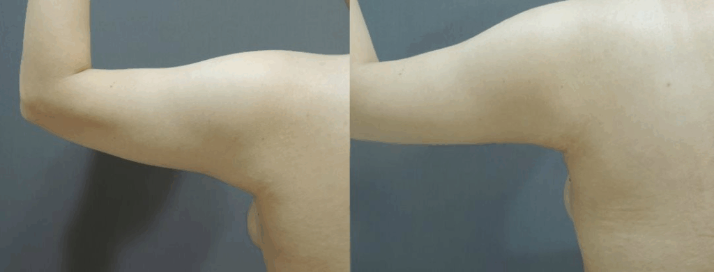 CASE 1 手臂抽脂2