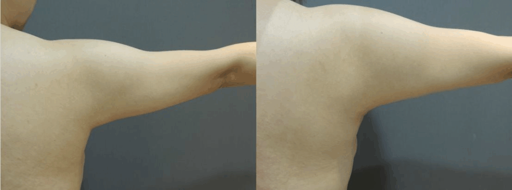 CASE 2 手臂抽脂1