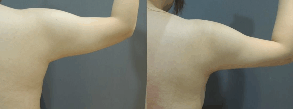 CASE 2 手臂抽脂2