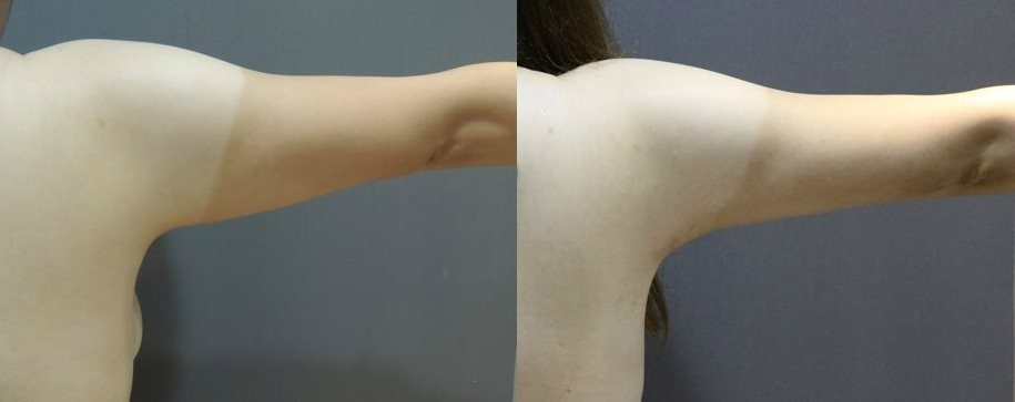 CASE 3 手臂抽脂1