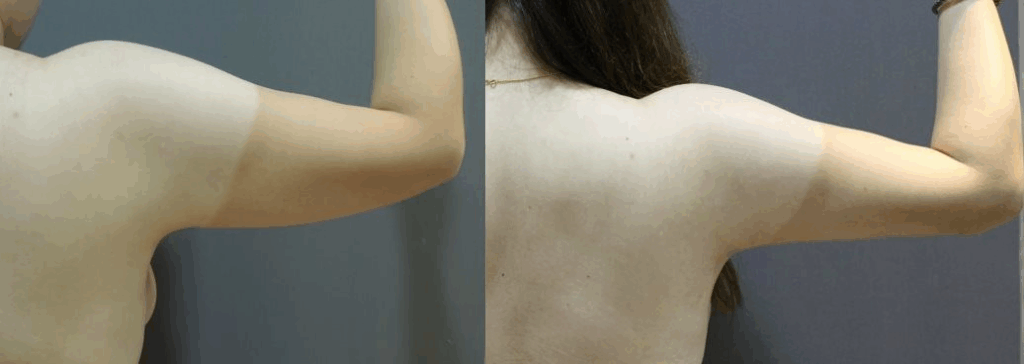 CASE 3 手臂抽脂2