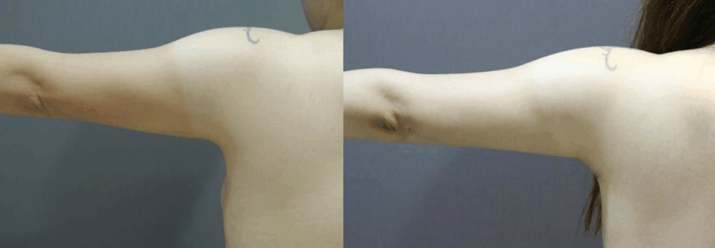 CASE 4 手臂抽脂1