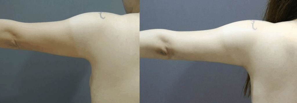 CASE 4 手臂抽脂2