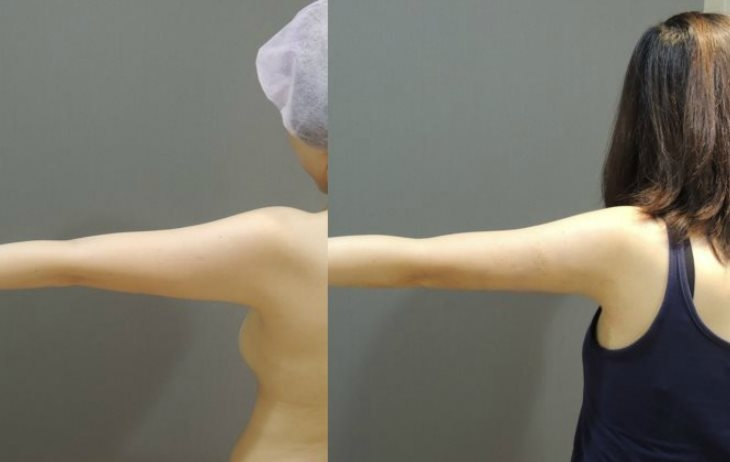 CASE 5 手臂抽脂1