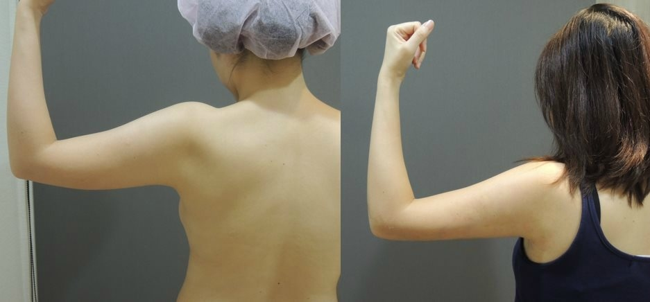 CASE 5 手臂抽脂2