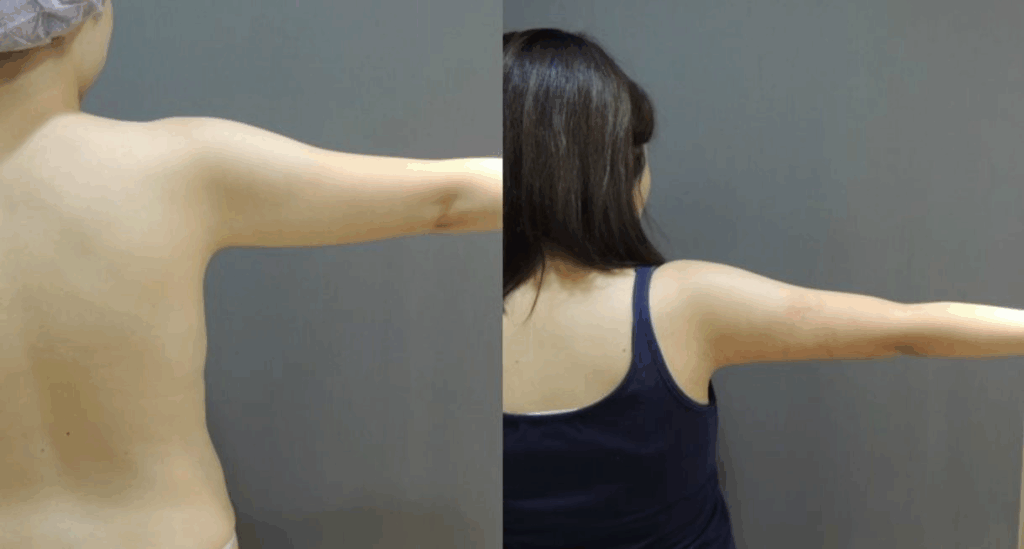 CASE 5 手臂抽脂3