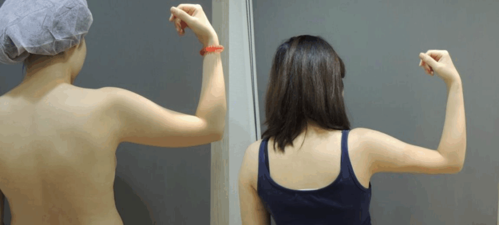 CASE 5 手臂抽脂4