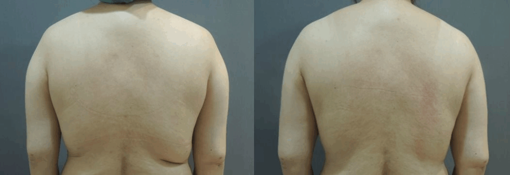 手臂抽脂 + 後背抽脂 案例1