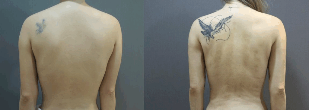 手臂抽脂 + 後背抽脂 案例2