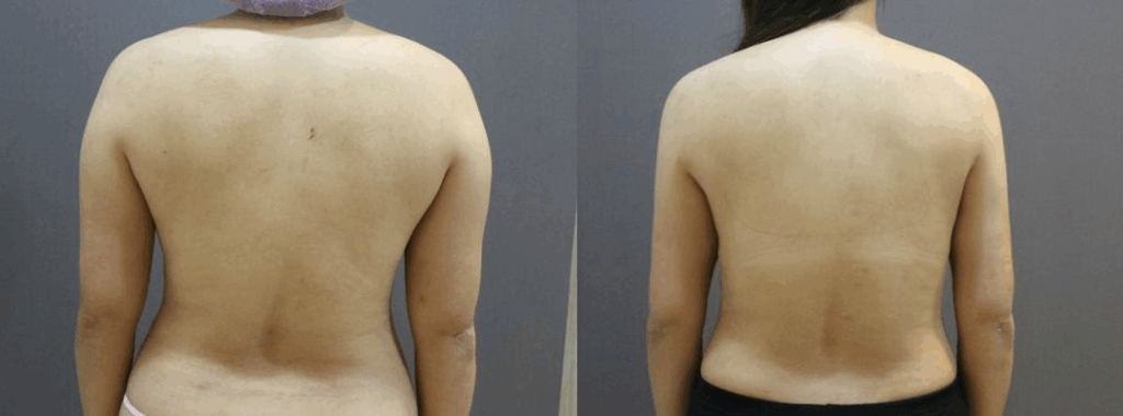 手臂抽脂 + 背部抽脂 案例3