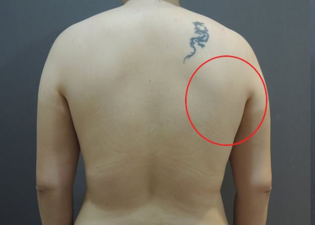 後副乳與背部抽脂示意圖