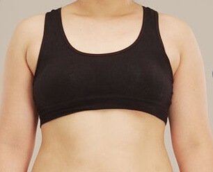 副乳抽脂術前術後案例照1