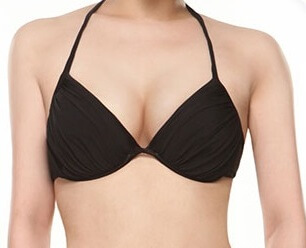 副乳抽脂術前術後案例照2