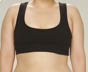 全身抽脂與隆乳術前照