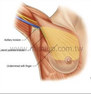 傳統腋下隆乳手術方式解析圖