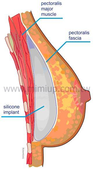 林敬鈞醫師觀點：什麼人適合筋膜下隆乳？