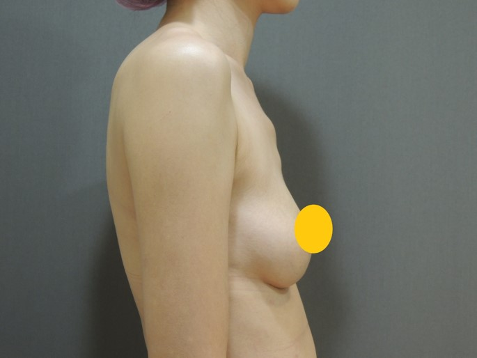 Case 2 術前側面照