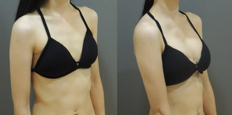 Case3  右45度角對比照