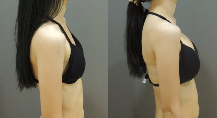 Case3 右側邊對比照