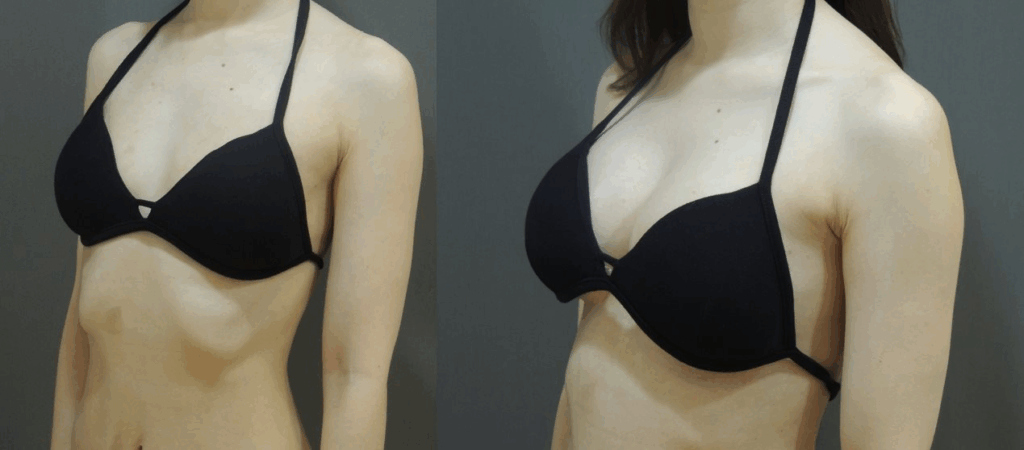 Case4 45度角對比照