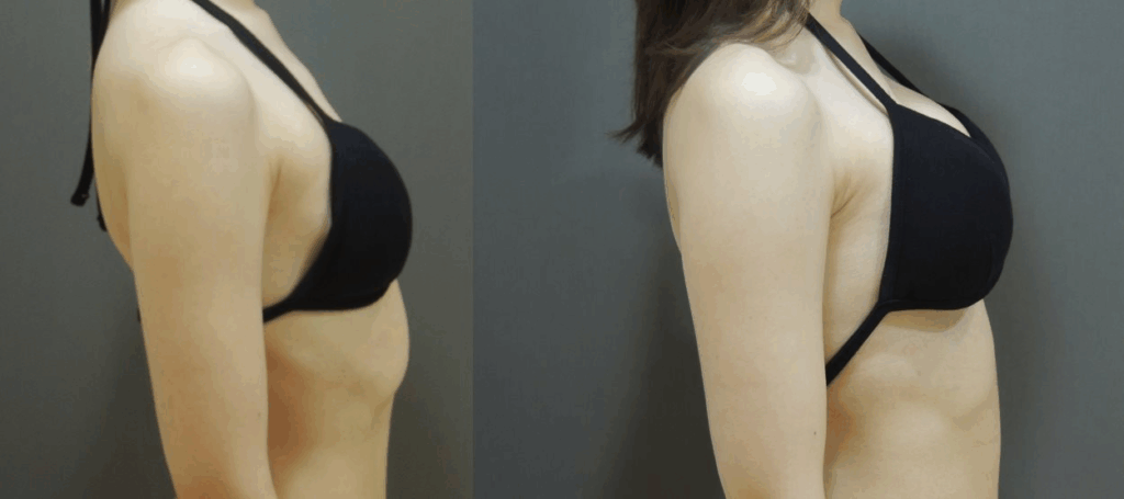 Case4 右側邊對比照