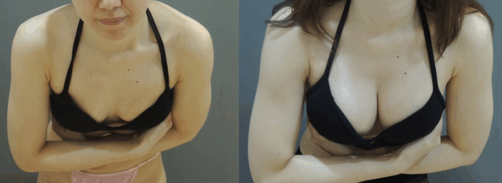 Case4 術前術後對比照