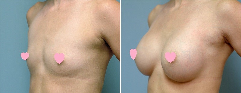 案例一：瘦小身材的自然水滴感