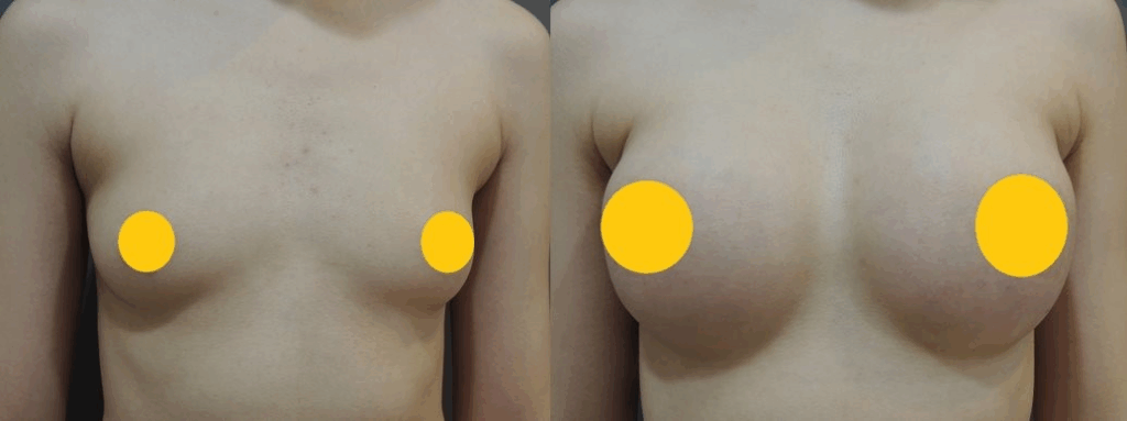 案例二：胸下緣放鬆與空間打造1