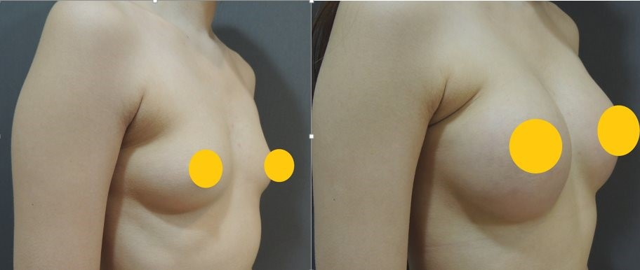 案例二：胸下緣放鬆與空間打造2