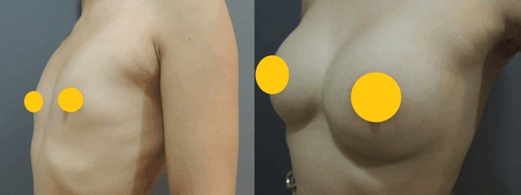 案例四：高大身形的筋膜下選擇