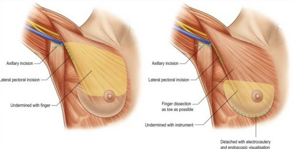 全程內視鏡腋下隆乳手術方式與流程