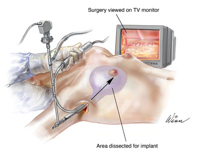 內視鏡需精準位置