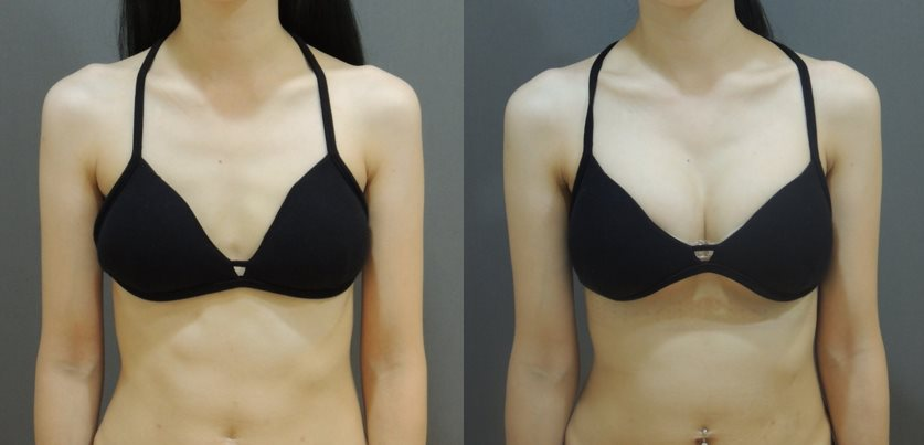 Case11 全程內視鏡腋下隆乳, A 升級 D前後對比