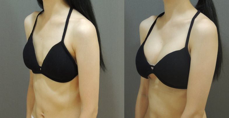 Case11 全程內視鏡腋下隆乳, A 升級 D前後對比2