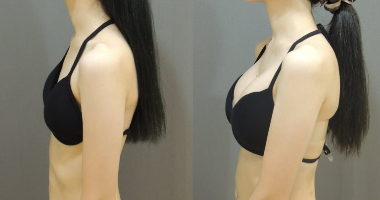 Case11 全程內視鏡腋下隆乳, A 升級 D前後對比3