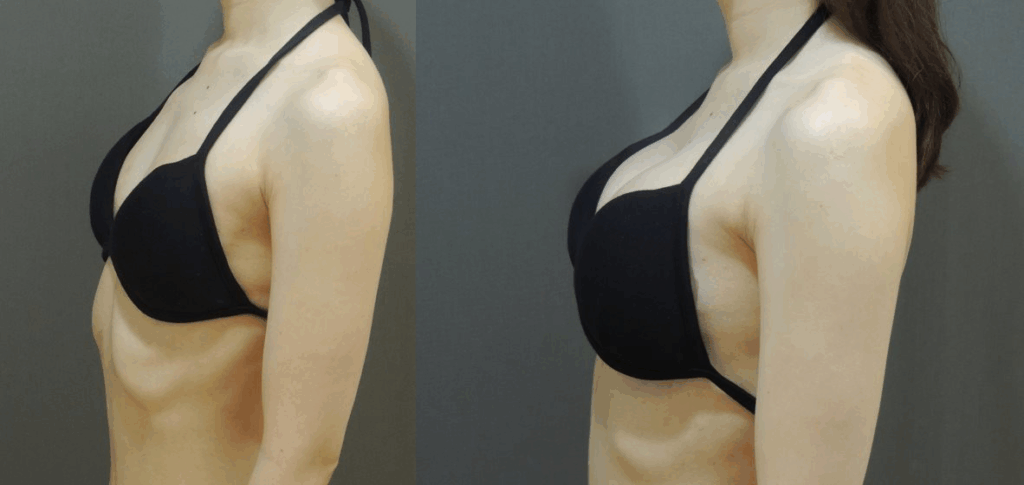 Case12 全程內視鏡腋下隆乳, AA 升級 大C 3