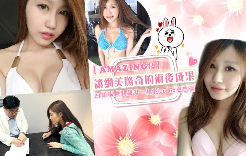 CASE 2 年輕平胸女孩前後比較圖