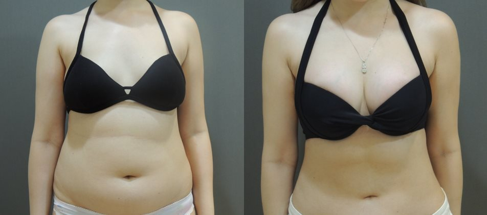 腹部環狀抽脂 + 果凍矽膠隆乳