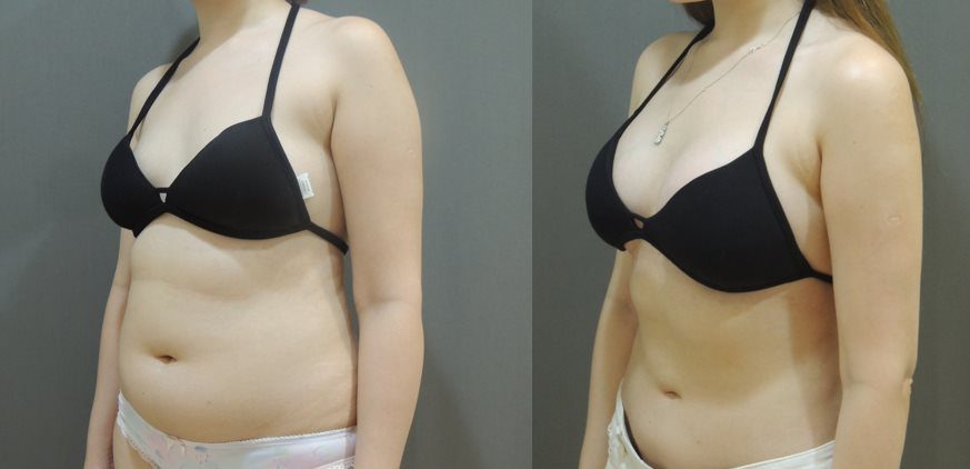 腹部環狀抽脂 + 果凍矽膠隆乳